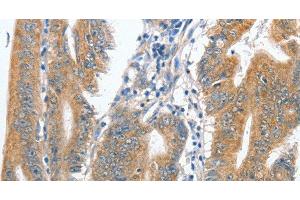 Immunohistochemistry of paraffin-embedded Human colon cancer tissue using CENPC Polyclonal Antibody at dilution 1:70