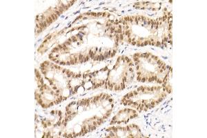 Immunohistochemistry of paraffin-embedded human colon carcinoma using TCE Rabbit mAb (ABIN7270877) at dilution of 1:25 (40x lens). (TCEA1 antibody)
