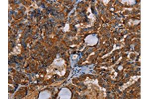 The image on the left is immunohistochemistry of paraffin-embedded Human thyroid cancer tissue using ABIN7191964(POU6F2 Antibody) at dilution 1/30, on the right is treated with synthetic peptide. (POU6F2 antibody)