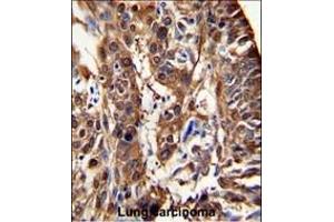 Formalin-fixed and paraffin-embedded human lung carcinoma reacted with ALDH3A1 Antibody (N-term), which was peroxidase-conjugated to the secondary antibody, followed by DAB staining. (ALDH3A1 antibody  (N-Term))