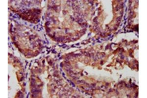 IHC image of ABIN7153467 diluted at 1:300 and staining in paraffin-embedded human endometrial cancer performed on a Leica BondTM system. (Galectin 9 antibody  (AA 1-323))