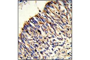 Formalin-fixed and paraffin-embedded human lung carcinoma reacted with  HADHA Antibody (C-term) followed which was peroxidase-conjugated to the secondary antibody, followed by DAB staining.