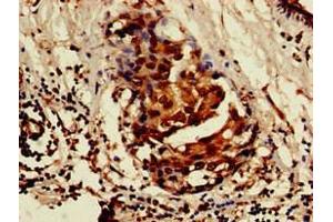 Immunohistochemistry of paraffin-embedded human breast cancer using ABIN7157103 at dilution of 1:100 (ISOC1 antibody  (AA 155-298))