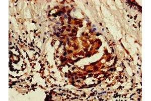 Immunohistochemistry of paraffin-embedded human breast cancer using ABIN7157103 at dilution of 1:100
