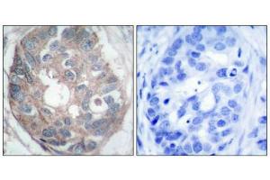 Immunohistochemical analysis of paraffin-embedded human breast carcinoma tissue using Dab1(Ab-232) Antibody(left) or the same antibody preincubated with blocking peptide(right). (DAB1 antibody)