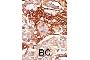 Formalin-fixed and paraffin-embedded human cancer tissue reacted with the primary antibody, which was peroxidase-conjugated to the secondary antibody, followed by AEC staining. (ARAF antibody  (AA 256-286))