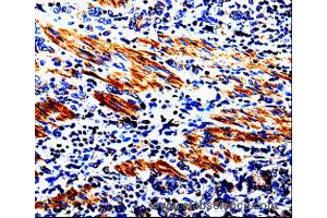 Immunohistochemistry of Human stomach cancer  using ACSBG2 Polyclonal Antibody at dilution of 1:60 (ACSBG2 antibody)