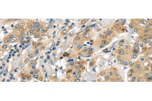 Immunohistochemistry of paraffin-embedded Human liver cancer using UTS2B Polyclonal Antibody at dilution of 1/35 (Urotensin 2B antibody)