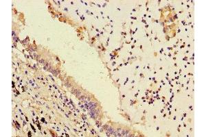 Immunohistochemistry of paraffin-embedded human lung cancer using ABIN7163357 at dilution of 1:100 (PPAP2B antibody  (AA 144-193))
