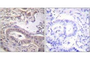 Immunohistochemistry analysis of paraffin-embedded human lung carcinoma, using BCL-XL (Phospho-Thr47) Antibody. (BCL2L1 antibody  (pThr47))