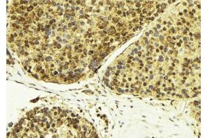 ABIN6274283 at 1/100 staining Human breast cancer tissue by IHC-P. (RBM5 antibody  (N-Term))