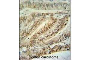CUL5 Antibody (C-term) (ABIN391834 and ABIN2841675) immunohistochemistry analysis in formalin fixed and paraffin embedded human colon carcinoma followed by peroxidase conjugation of the secondary antibody and DAB staining.