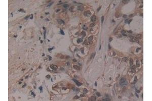 Detection of ADAMTS5 in Human Pancreatic cancer Tissue using Polyclonal Antibody to A Disintegrin And Metalloproteinase With Thrombospondin 5 (ADAMTS5) (ADAMTS5 antibody  (AA 485-622))
