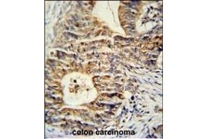 KLHL24 Antibody (Center) (ABIN651431 and ABIN2840236) immunohistochemistry analysis in formalin fixed and paraffin embedded human colon carcinoma followed by peroxidase conjugation of the secondary antibody and DAB staining. (Kelch-Like 24 antibody  (AA 182-211))