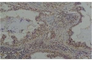 Immunohistochemistry of paraffin-embedded Human lung carcinoma tissue with Phosphoserine Monoclonal Antibody at dilution of 1:200 (Phosphoserine antibody)