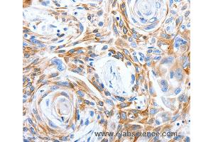 Immunohistochemistry of Human esophagus cancer using LRIG3 Polyclonal Antibody at dilution of 1:50 (LRIG3 antibody)