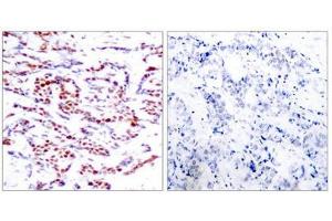 Immunohistochemical analysis of paraffin-embedded human breast carcinoma tissue using ATF2(Phospho-Thr71 or 53) Antibody(left) or the same antibody preincubated with blocking peptide(right). (ATF2 antibody  (pThr71))