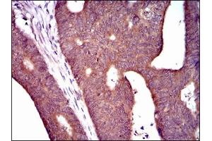 Immunohistochemical analysis of paraffin-embedded rectum cancer tissues using PDE1B mouse mAb with DAB staining. (PDE1B antibody  (AA 370-536))