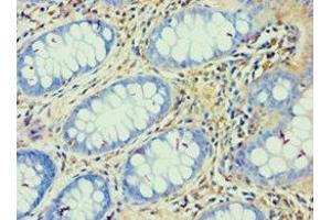 Immunohistochemistry of paraffin-embedded human colon cancer using ABIN7144823 at dilution of 1:100 (ATP5F1 antibody  (AA 1-245))