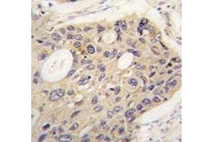IHC analysis of FFPE human lung carcinoma tissue stained with ATG12 antibody (ATG12 antibody)