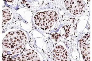 ABIN6276373 at 1/200 staining human Breast cancer tissue sections by IHC-P. (CDK4 antibody  (Internal Region))