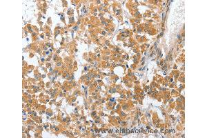 Immunohistochemistry of Human liver cancer using CHMP4B Polyclonal Antibody at dilution of 1:40 (CHMP4B antibody)
