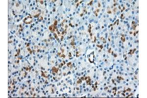 Immunohistochemical staining of paraffin-embedded Adenocarcinoma of Human ovary tissue using anti-BDH2 mouse monoclonal antibody. (BDH2 antibody)