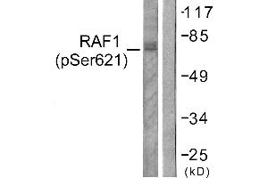 Immunohistochemistry analysis of paraffin-embedded human lung carcinoma tissue using Raf1 (Phospho-Ser621) antibody.