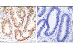 Immunohistochemistry analysis of paraffin-embedded human colon carcinoma, using p38 MAPK (Phospho-Tyr182) Antibody.
