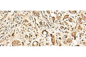 Immunohistochemistry of paraffin-embedded Human prost ate cancer tissue using SOX3 Polyclonal Antibody at dilution of 1:50(x200) (SOX3 antibody)