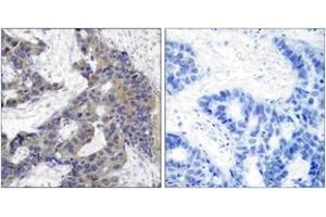 Immunohistochemistry analysis of paraffin-embedded human breast carcinoma tissue, using JAK2 (Ab-1007) Antibody.