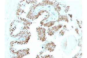 Formalin-fixed, paraffin-embedded human Prostate Carcinoma stained with p57 Mouse Monoclonal Antibody (SPM308).