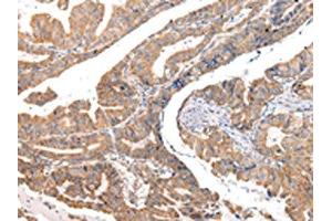 The image on the left is immunohistochemistry of paraffin-embedded Human esophagus cancer tissue using ABIN7190330(COL8A2 Antibody) at dilution 1/20, on the right is treated with synthetic peptide. (COL8a2 antibody)