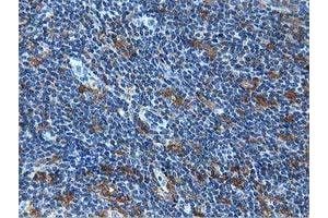 Immunohistochemical staining of paraffin-embedded Human lymphoma tissue using anti-MICAL1 mouse monoclonal antibody.