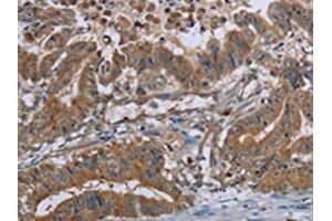 The image on the left is immunohistochemistry of paraffin-embedded Human esophagus cancer tissue using ABIN7130067(LCMT1 Antibody) at dilution 1/20, on the right is treated with fusion protein. (LCMT1 antibody)