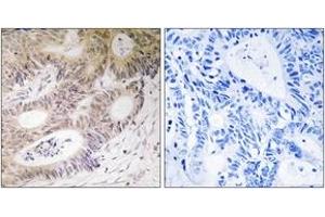 Immunohistochemistry analysis of paraffin-embedded human colon carcinoma tissue, using MSK1 (Ab-212) Antibody. (MSK1 antibody  (AA 181-230))