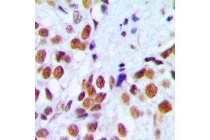 Immunohistochemical analysis of RAD54A staining in human breast cancer formalin fixed paraffin embedded tissue section. (RAD54L antibody)
