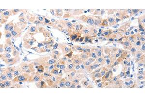 Immunohistochemistry of paraffin-embedded Human lung cancer using CDK7 Polyclonal Antibody at dilution of 1:30 (CDK7 antibody)