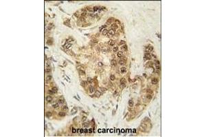 Formalin-fixed and paraffin-embedded human breast carcinoma tissue reacted with CDK2 Antibody (T14) (ABIN1881192 and ABIN2841623) , which was peroxidase-conjugated to the secondary antibody, followed by DAB staining. (CDK2 antibody  (AA 1-30))