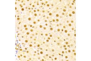 Immunohistochemistry of paraffin-embedded human liver damage using CDC25A antibody (ABIN3021625, ABIN3021626, ABIN3021627 and ABIN6215426) at dilution of 1:100 (40x lens). (CDC25A antibody  (AA 235-484))
