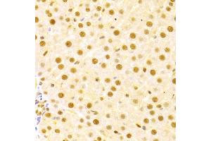 Immunohistochemistry of paraffin-embedded human liver damage using CDC25A antibody (ABIN3021625, ABIN3021626, ABIN3021627 and ABIN6215426) at dilution of 1:100 (40x lens). (CDC25A antibody  (AA 235-484))