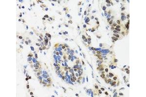 Immunohistochemistry of paraffin-embedded Human gastric cancer using TOP1 Polyclonal Antibody at dilution of 1:100 (40x lens). (Topoisomerase I antibody)