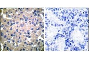 Immunohistochemistry analysis of paraffin-embedded human breast carcinoma tissue, using Transglutaminase 2 Antibody. (Transglutaminase 2 antibody  (AA 1-50))