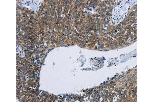 Immunohistochemistry of Human thyroid cancer using KPNB1 Polyclonal Antibody at dilution of 1:40