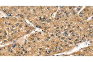 Immunohistochemistry of paraffin-embedded Human liver cancer tissue using STX8 Polyclonal Antibody at dilution 1:45