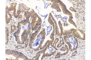 ABIN7094835 and ABIN7098886 at 1/100 staining Human colorectal cancer by IHC-P. (desert Hedgehog antibody  (N-Term))