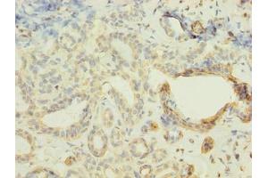 Immunohistochemistry of paraffin-embedded human breast cancer using ABIN7152421 at dilution of 1:100 (FBXO28 antibody  (AA 251-368))