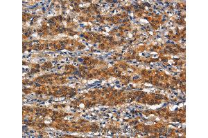 Immunohistochemistry of Human thyroid cancer using ANPEP Polyclonal Antibody at dilution of 1:80 (CD13 antibody)