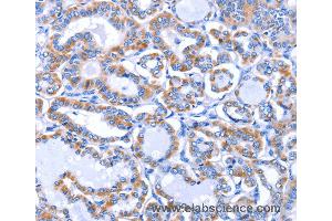 Immunohistochemistry of Human thyroid cancer using GJB3 Polyclonal Antibody at dilution of 1:30 (Connexin 31 antibody)