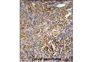 TANK Antibody (Center) (ABIN652041 and ABIN2840515) immunohistochemistry analysis in formalin fixed and paraffin embedded human cervix carcinoma followed by peroxidase conjugation of the secondary antibody and DAB staining. (TANK antibody  (AA 88-114))